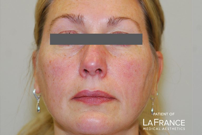 Laser Spider Vein Removal - LaFrance - Medical Aesthetics Clinic In Central  Connecticut