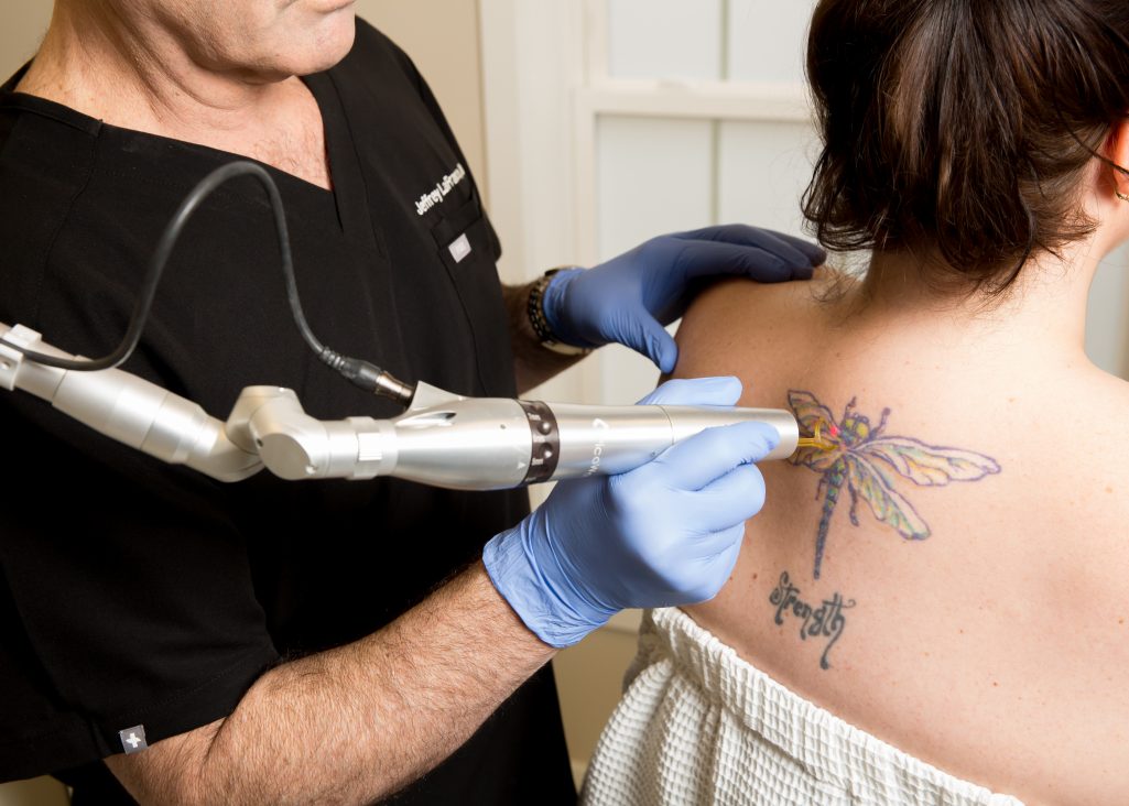 Tattoo Removal In South Windsor  West Hartford CT